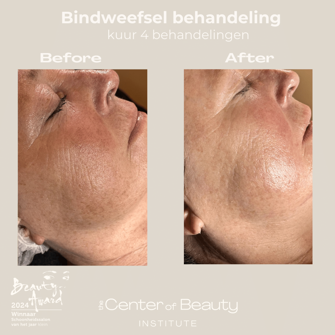 Resultaat behandeling